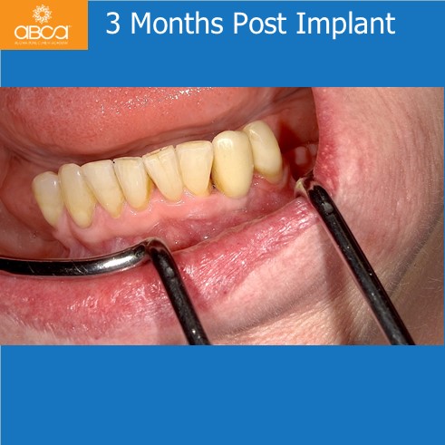 3 Months Post Implant