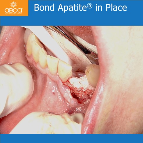 Bond Apatite® in Place
