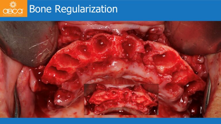 Maxillary Rehabilitation with Immediate All-on-4