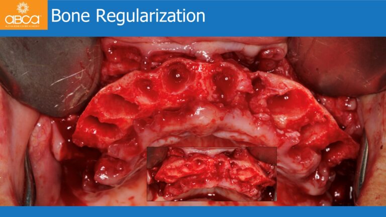 Maxillary Rehabilitation with Immediate All-on-4