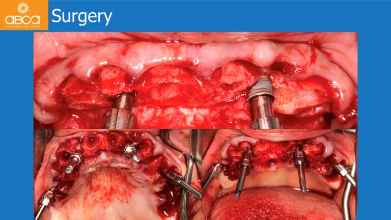 Maxillary Rehabilitation with Immediate All-on-4