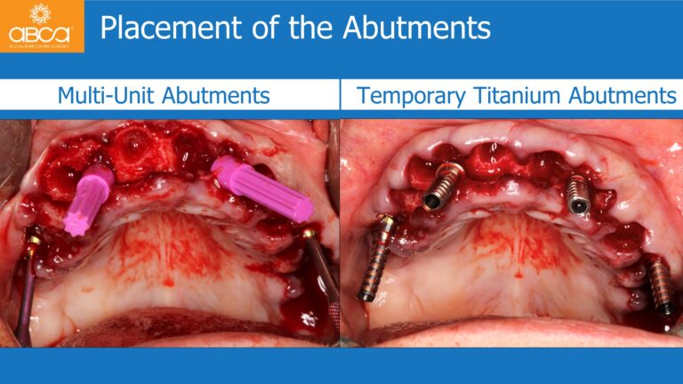 Maxillary Rehabilitation with Immediate All-on-4