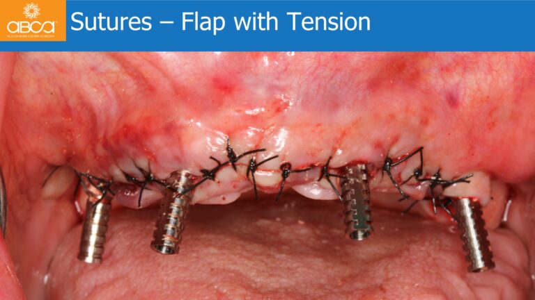 Maxillary Rehabilitation with Immediate All-on-4