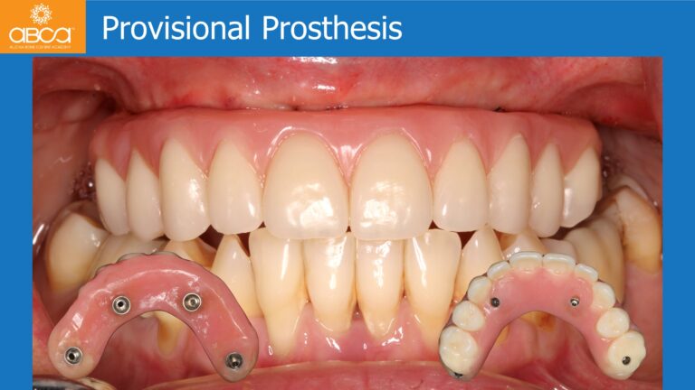 Maxillary Rehabilitation with Immediate All-on-4