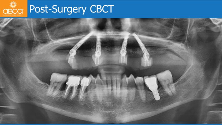 Maxillary Rehabilitation with Immediate All-on-4