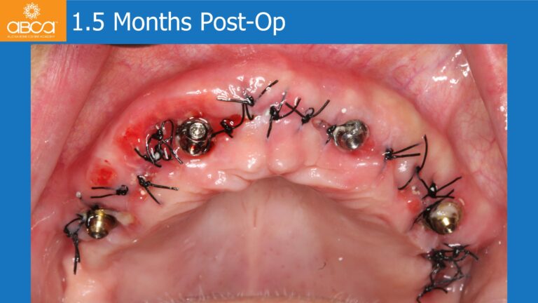 Maxillary Rehabilitation with Immediate All-on-4