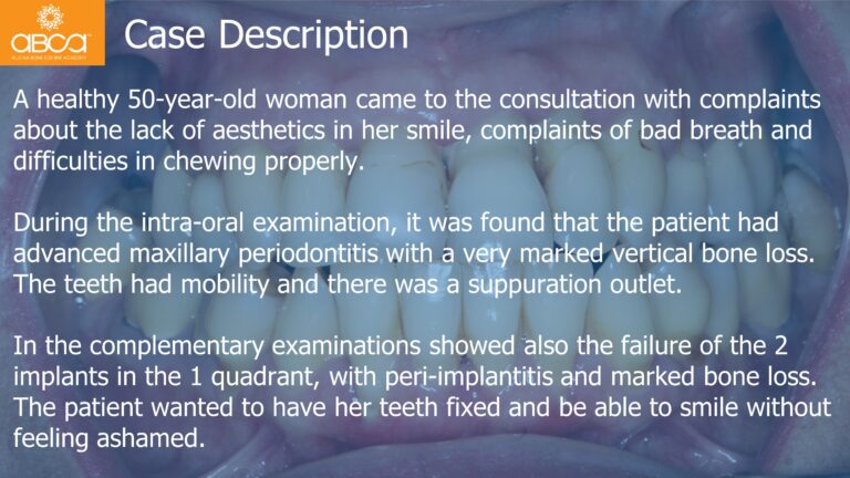 Maxillary Rehabilitation with Immediate All-on-4