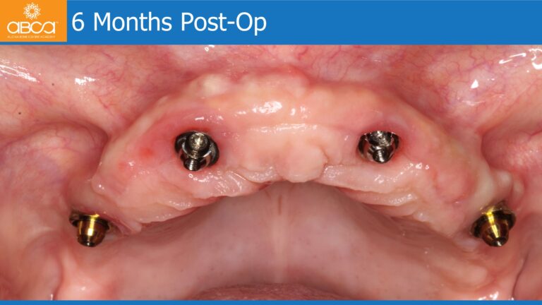 Maxillary Rehabilitation with Immediate All-on-4