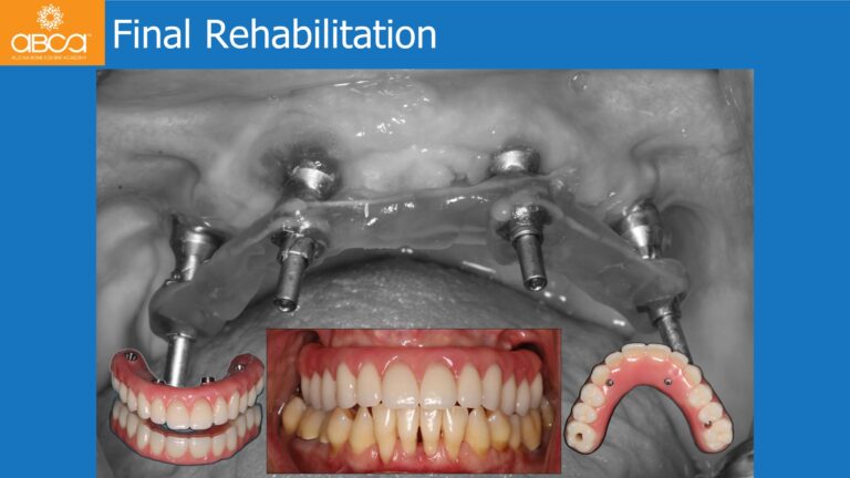 Maxillary Rehabilitation with Immediate All-on-4