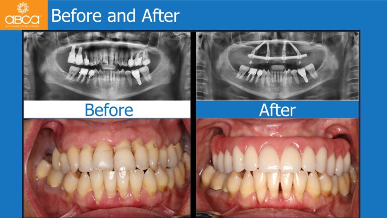 Maxillary Rehabilitation with Immediate All-on-4