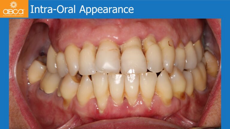 Maxillary Rehabilitation with Immediate All-on-4