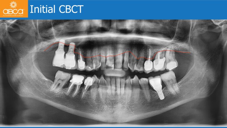 Maxillary Rehabilitation with Immediate All-on-4