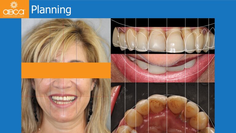 Maxillary Rehabilitation with Immediate All-on-4