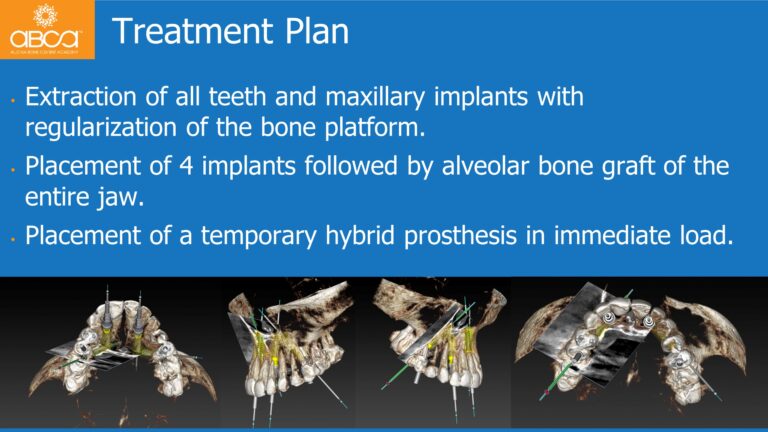 Maxillary Rehabilitation with Immediate All-on-4