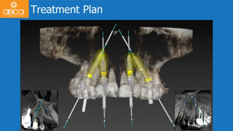 Maxillary Rehabilitation with Immediate All-on-4