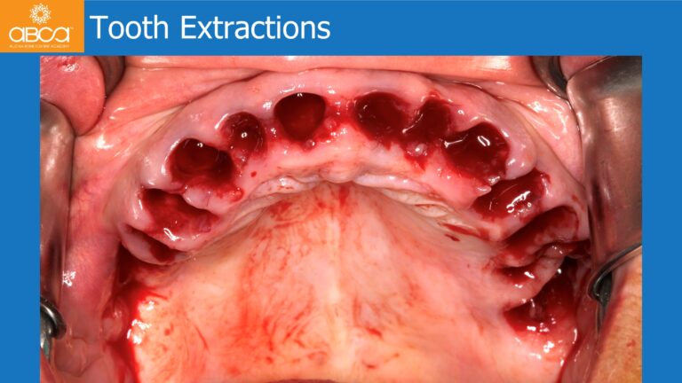 Maxillary Rehabilitation with Immediate All-on-4