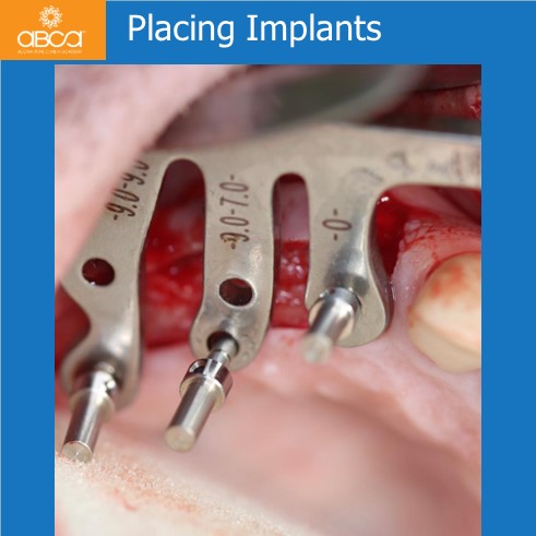 Implants and Grafts