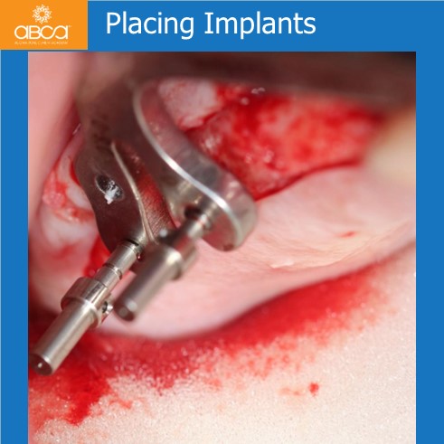 Implants and Grafts