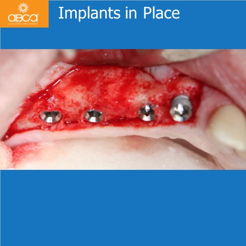 Implants and Grafts