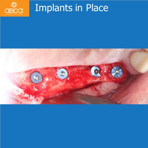 Implants and Grafts