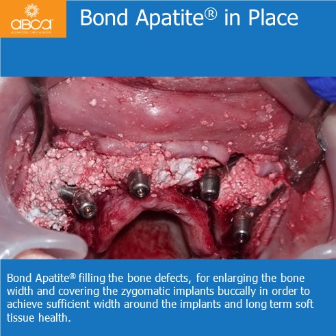 Immediate Loading in an Atrophied Maxilla