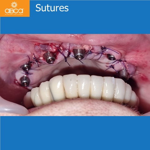 Immediate Loading in an Atrophied Maxilla