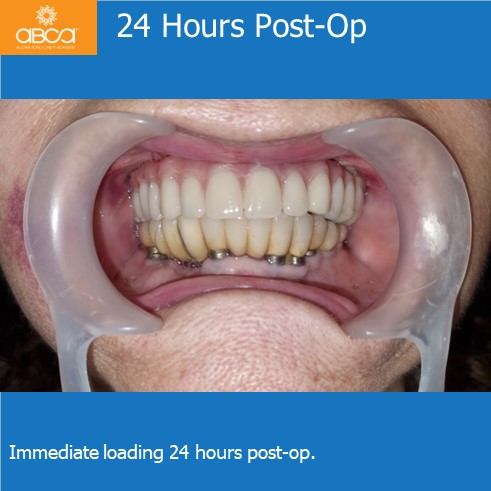 Immediate Loading in an Atrophied Maxilla