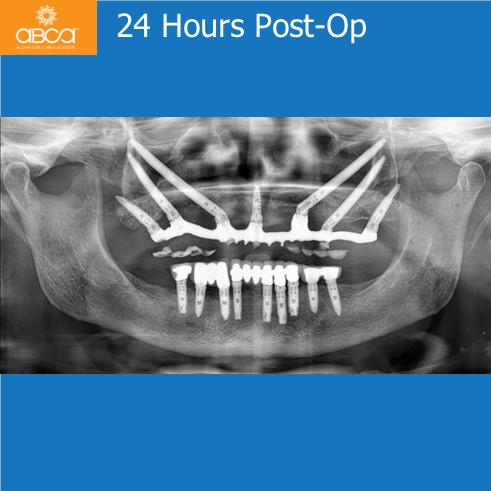 Immediate Loading in an Atrophied Maxilla