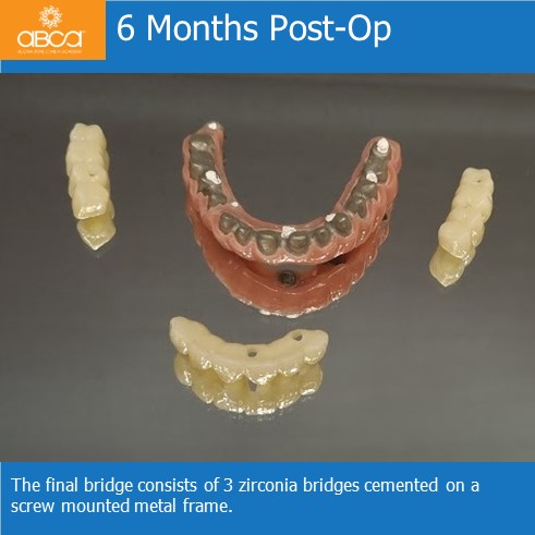 Immediate Loading in an Atrophied Maxilla