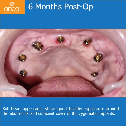 Immediate Loading in an Atrophied Maxilla