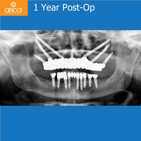 Immediate Loading in an Atrophied Maxilla