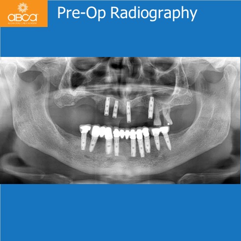 Immediate Loading in an Atrophied Maxilla