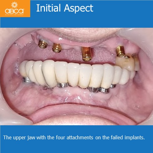 Immediate Loading in an Atrophied Maxilla