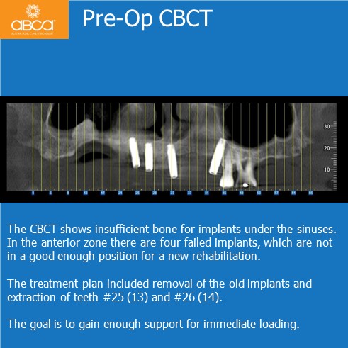 Immediate Loading in an Atrophied Maxilla