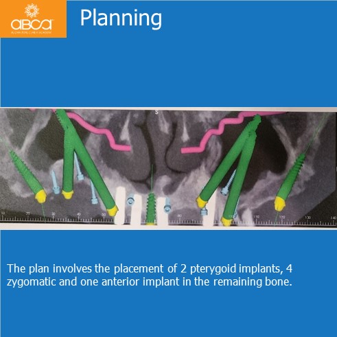 Immediate Loading in an Atrophied Maxilla