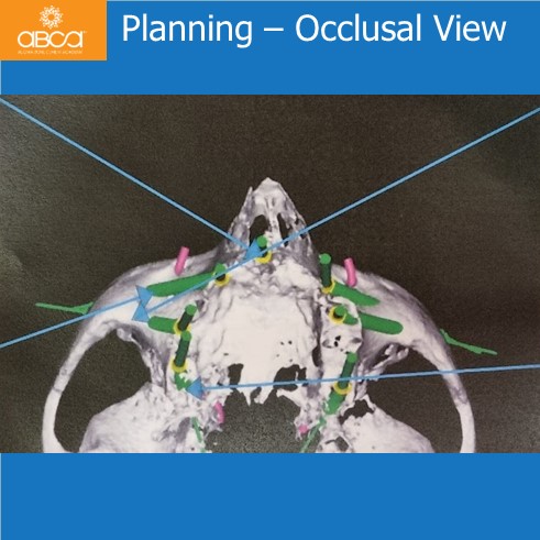 Immediate Loading in an Atrophied Maxilla