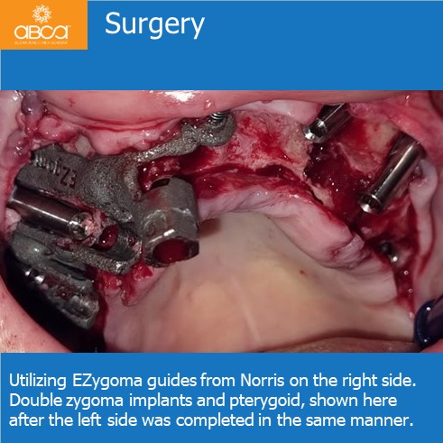 Immediate Loading in an Atrophied Maxilla