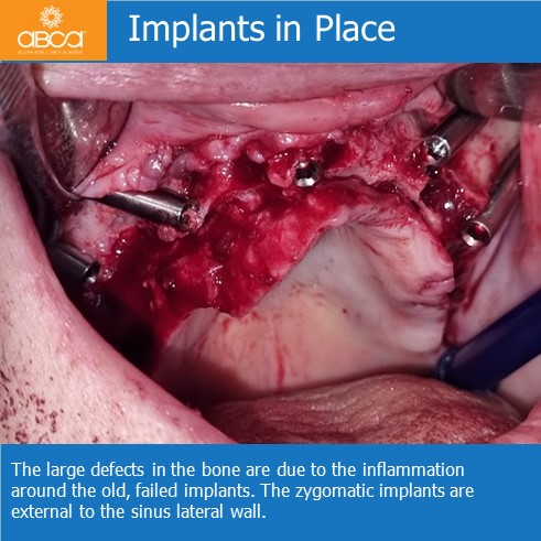 Immediate Loading in an Atrophied Maxilla