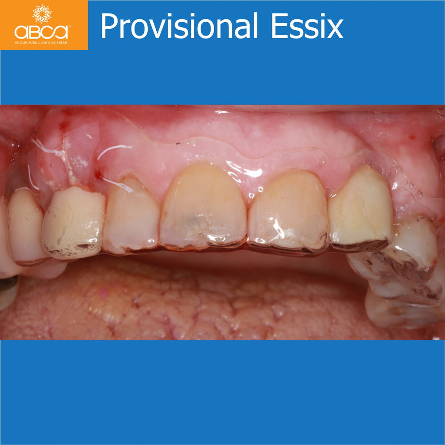 Provisional Essix