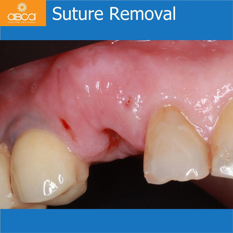 Suture Removal