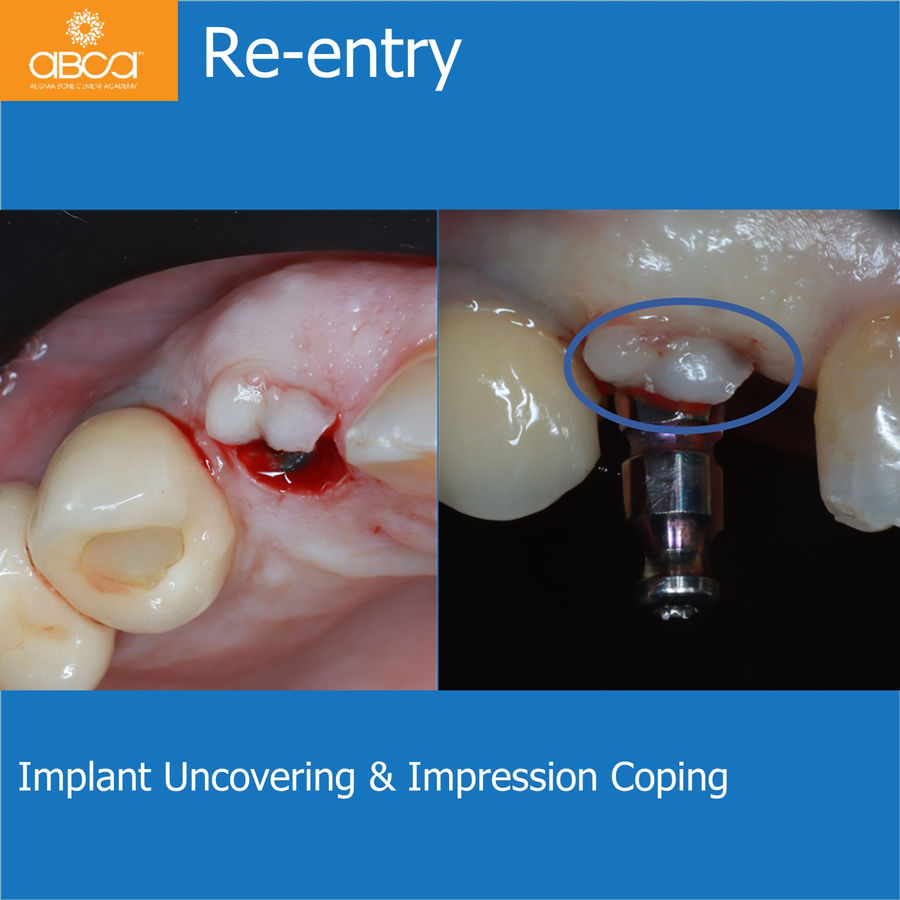 Re-entry | Implant Uncovering & Impression Coping
