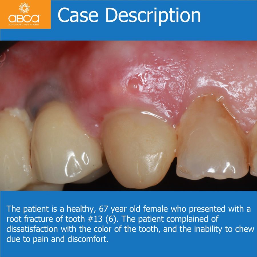 Case Description | The patient is a healthy, 67 year old female who presented with a root fracture of tooth #13 (6). The patient complained of dissatisfaction with the color of the tooth, and the inability to chew due to pain and discomfort.