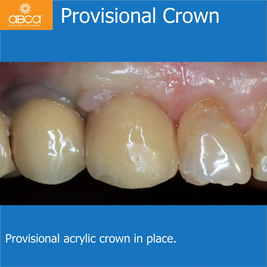 Provisional Crown | Provisional acrylic crown in place.
