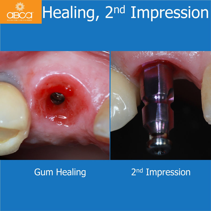 Healing, 2nd Impression | Gum Healing & 2nd Impression