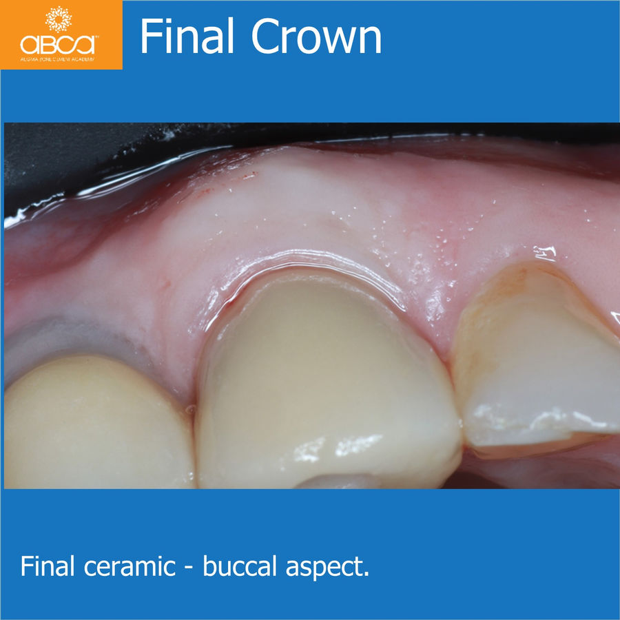 Final Crown | Final ceramic - buccal aspect.