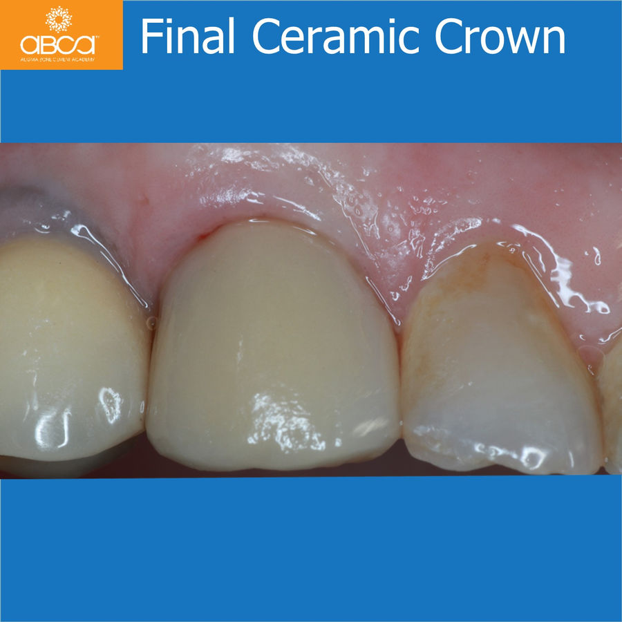 Final Ceramic Crown