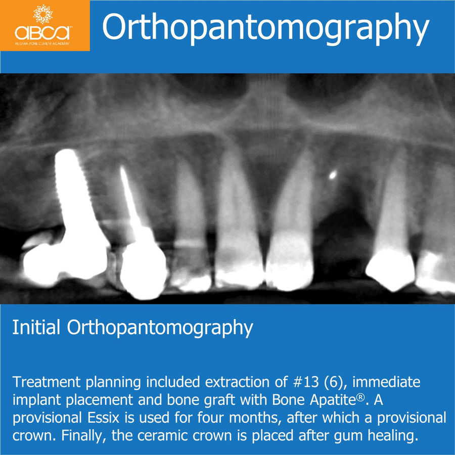 Orthopantomography | Initial Orthopantomography | Treatment planning included extraction of #13 (6), immediate implant placement and bone graft with Bone Apatite®. A provisional Essix is used for four months, after which a provisional crown. Finally, the ceramic crown is placed after gum healing.