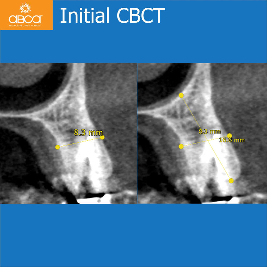 Initial CBCT | 2