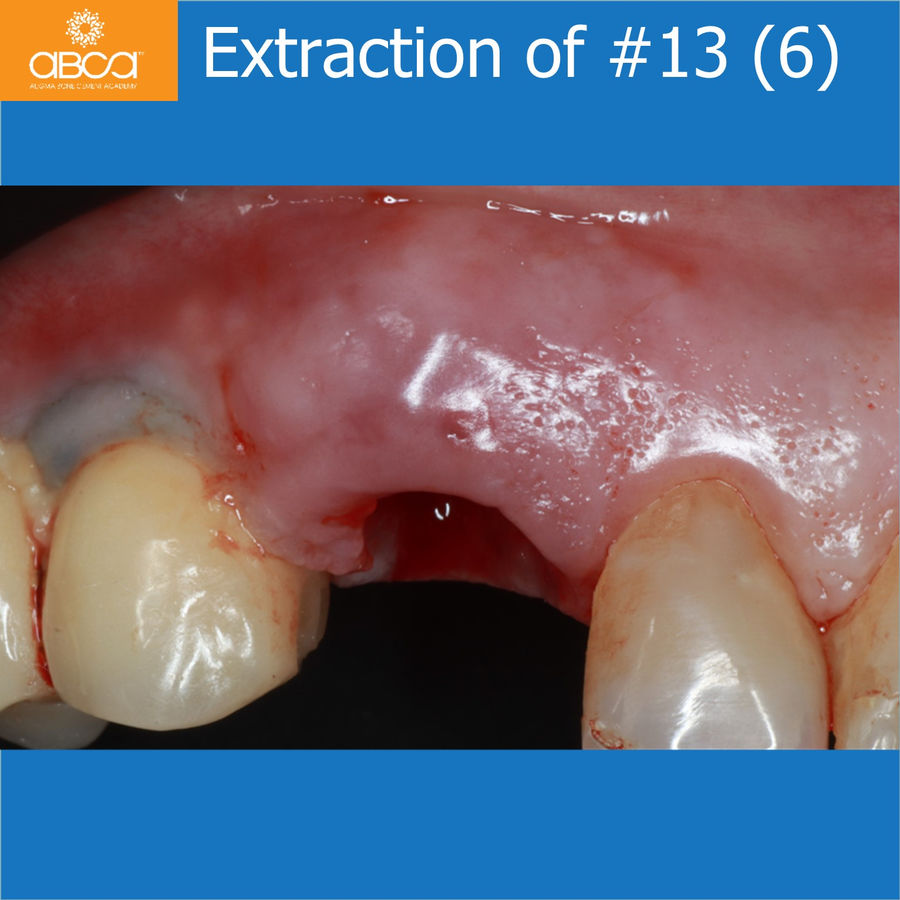Extraction of #13 (6)