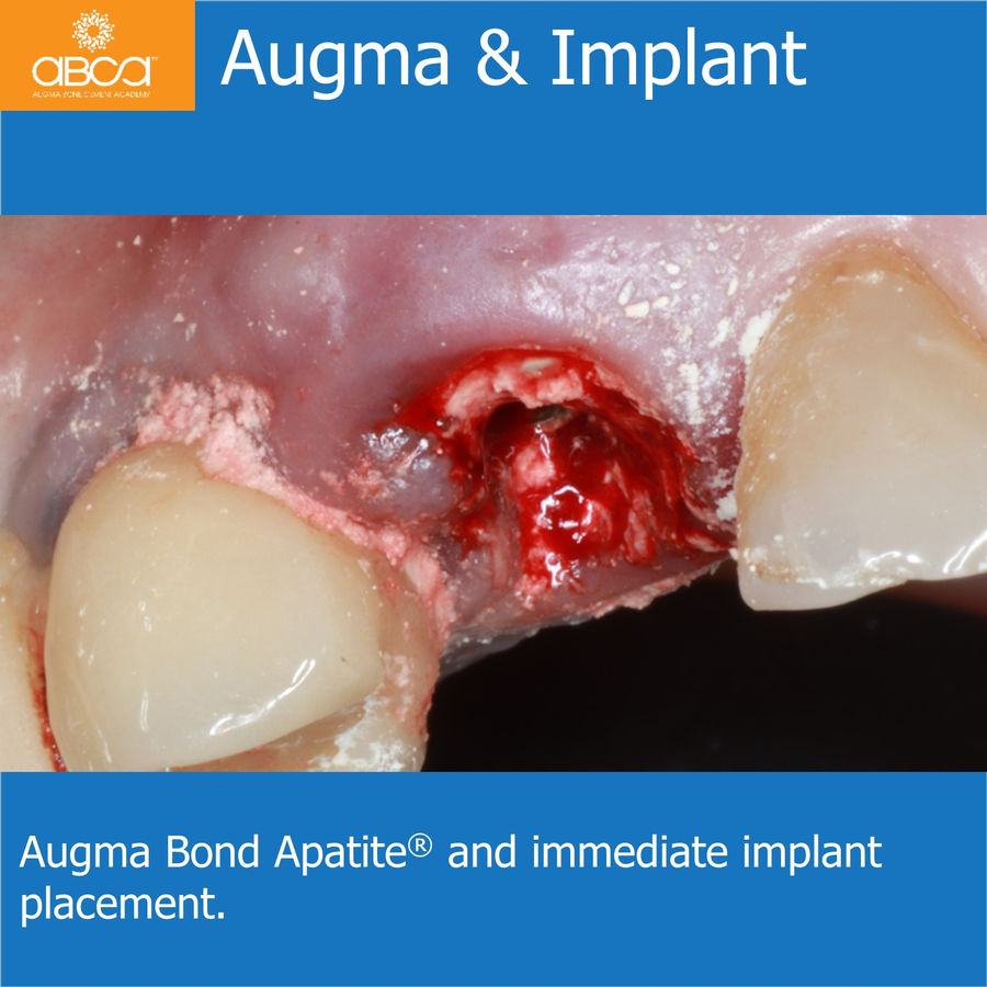 Augma & Implant | Augma Bond Apatite and immediate implant placement.